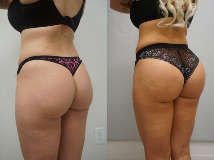 Why This Plastic Surgeon Refuses to Perform Brazilian Butt Lifts (BBL)